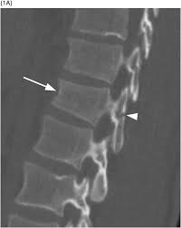 Image result for Chance Fracture