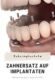 Fehlt Ein Oder Mehrere Zahne Benotigt Man Einen Zahnersatz Welche Vorteile Bieten Implantate Zahnersatz Zahne Implantat Zahn