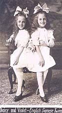 Ladan bijani and laleh bijani (in persian: Dewiki Siamesische Zwillinge