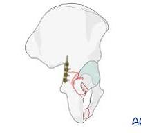 ORIF through Kocher-Langenbeck for Posterior column and wall