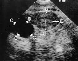 Certain exams require placement of a designated sterile transducer probe into the vagina. Diagnostic Ultrasonography In Gynecology Glowm