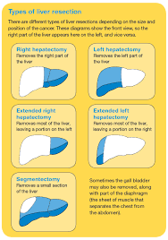 A large percentage of these tumors occur in children who are born premature. Primary Liver Cancer Cancer Council Victoria