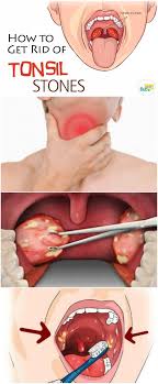 Black And White Spots On Tonsils Pin On Skin And Health