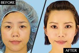 Considering plastic surgery in the bay area? Plastic Surgeons Dispel The Common Misconception Behind Asian Double Eyelid Surgery Newbeauty