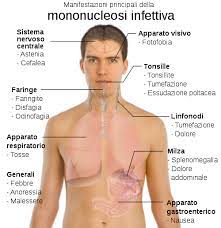 Jun 25, 2021 · mononucleosi sintomi e terapia per curarla — la mononucleosi infettiva, soprattutto nei bambini, si può spesso manifestare in forma subclinica, quindi senza sintomi importanti, invece negli adulti può provocare sintomi di diverso tipo, da quelli più lievi a quelli più gravi. File Main Symptoms Of Infectious Mononucleosis It Svg Wikimedia Commons