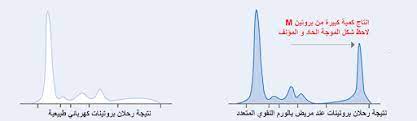 الورم النقوي المتعدد multiple myeloma multiple myeloma myeloma chart