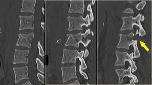 Despite these findings, pankovich' considered the maisonneuve fracture a severe injury to the ankle with complete diastasis of the syndesmosis. The Radiology Assistant Thoracolumbar Injury