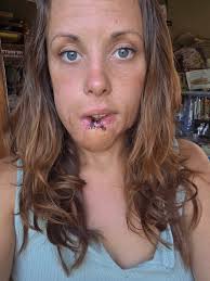 Successful surgical procedure recovery update