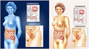 Die leistenregion weist mit dem leistenkanal (canalis inguinalis) beziehungsweise dessen innerem zugang („innerer leistenring, anulus inguinalis profundus) eine natürliche schwachstelle auf. Leistenbruch Ursachen Symptome Behandlung Medlexi De