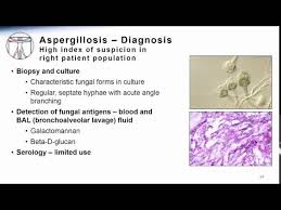 Most people breathe in aspergillus spores every day without getting sick. Aspergillosis Youtube