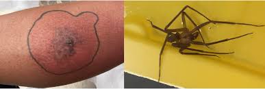 Image result for yellow sac spider bite skin