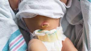 After the umbilical cord is cut at birth, a stump of tissue remains attached to your baby's belly button (navel). Umbilical Cord Care Guide For Newborns