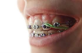 Let's take a look at the effect of not wearing the rubber bands for braces. Do I Really Need To Wear My Rubber Bands With My Braces Raleighhillsortho Rubber Bands Orthodontic Rubber Bands Dental Braces