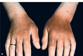 Image result for PHOTOSENSITIZATION IN UVR