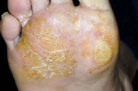 We did not find results for: Hand And Foot Dermatitis Skin Disorders Msd Manual Consumer Version