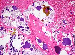 Image result for Kayexalate