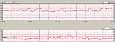 Image result for Non-Stress Test