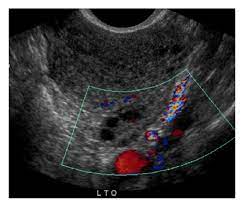 If a male sonographer is doing the scan, there will need to be a female chaperone present for the transvaginal or translabial portion of the exam. Pelvic Ultrasound 5 31 13 Unremarkable Scan Picture Showing Normal Download Scientific Diagram