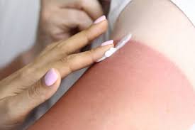 ‫آفتاب سوختگی چیست؟ | علائم + 17 روش خانگی درمان آفتاب سوختگی‬‎