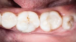 While some swelling is normal after this procedure, the good news is that you have some control over your swelling. 9 Important Facts About Wisdom Teeth And Tooth Removal Webdento