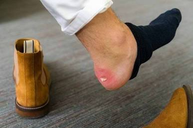 Tekanan dan gesekan berlebih dari sepatu ketat dapat memicu iritasi serta lecet pada kulit., AI generated