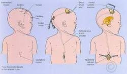 Vp Shunt Hydrocephalus Surgery In Nagpur Civil Lines By Travcure Medical Tourism Private Limited Id 10699613355
