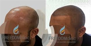Scammers will do anything to get your money. Products For Maintaing Smp Scalp Micro Pigmentations Procedures