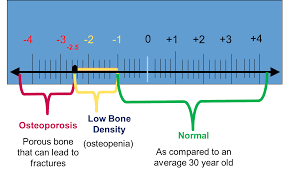 Understanding Bone Density Results American Bone Health