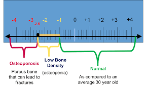 Newly Diagnosed American Bone Health