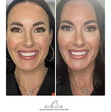 Before & After! Dr. Blackledge performed a lower blepharoplasty