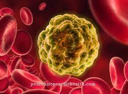 Perangkat baru penghitung sel darah itu diberi nama hemacam. Leukemia Myeloid Kronik Punca Gejala Rawatan Penyakit