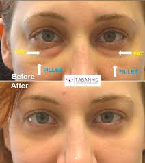 Lower Blepharoplasty After Hyaluronidase Injection After Previous Filler Eye Bag Surgery Under Eye Fillers Injectables Fillers