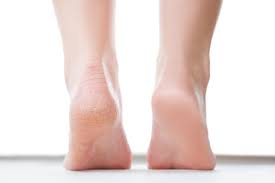 How Do Podiatrists Remove Cracked Heels