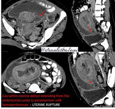 Dr Ankit Balani Dmrd Dnb Frcr On Twitter Answer For This Case Uterine Rupture With Endometritis And Hemoperitoneum Imaging May Not Be Able To Differentiate Between Uterine Dehiscence And Rupture Radres Foamed