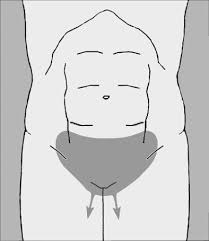 Image result for Pubic Apophysitis