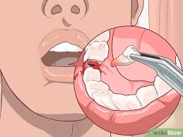 Zahnfleisch Nach Der Extraktion Eines Zahns Heilen Wikihow