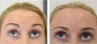My Face Looks Wrinkled And Old Would Anti Wrinkle Injections Help