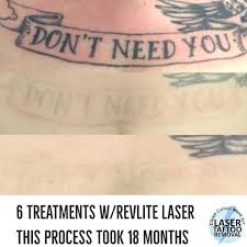 How to remove a tattoo successfully with medical lasers. Clean Canvas More Art Laser Tattoo Removal Tattoodo