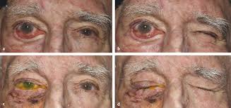 Please complete the form below and a representative will contact you within three business days to confirm your scheduled appointment. 16 Upper Eyelid Gold Platinum Weight Placement Ento Key