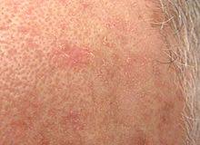 18.09.2015 · an actinic keratosis (ak) or solar keratosis is a scaly or crusty growth on the skin indicative of sustained damage by the sun. Actinic Keratosis Wikipedia