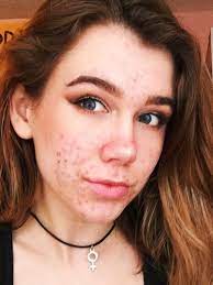 Jul 28, 2020 · doxycycline can take 3 to 7 days to work. Teen Says Acne Medication Doxycycline Led To Her Vision Loss Allure