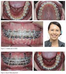 How to fix a gummy smile with braces. Gummy Smile An Often Untreated Condition Orthodontic Practice Us