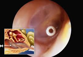 The most common cause of this infection is bacteria invading the skin inside your ear canal. Ear Infection Symptoms Causes And Treatment