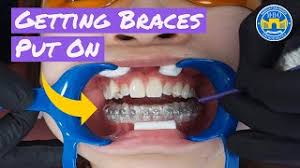 Braces are an orthodontic treatment, which means they are not typically covered by medicare because they are usually done for cosmetic reasons. Process Of Getting Braces Youtube