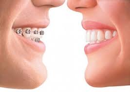 However, i have heard people with similar cases as me who have their treatment using metal braces in less than a year. Fixed Metal Braces Faces And Smiles