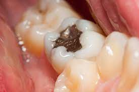 My Tooth Filling Fell Out What To Do Wilkinson Dental