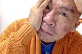 BOLOOTHONG 2017. An Attack of Chicken Pox to Adults Can Produce Serious  Complications and It Has Concerned Me More Than Those Itchy Blister Rashes  Themselves. This is the Worst Nightmare for Those