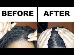 It's a delicate task to maintain the there's one surefire way to assure that your scalp retains these natural oils: How To Get Rid Of Dry Itchy Scalp In 15 Mins Without Washing Your Locs Youtube