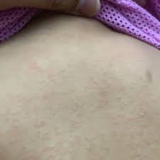 Demam campak adalah demam ruam yang disebabkan jangkitan virus measles. Viralrashes Instagram Posts Photos And Videos Picuki Com