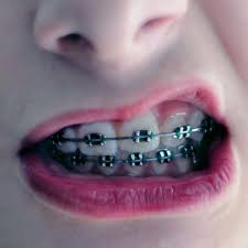 Pin By Mazinger Z On Art Photography Cute Braces Colors Cute Braces Getting Braces